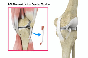 ACL Reconstruction with Patellar Tendon