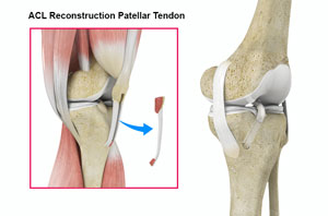 ACL Reconstruction of Patellar Tendon