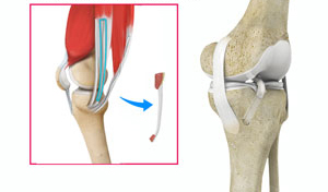 ACL Reconstruction with Hamstring Tendon
