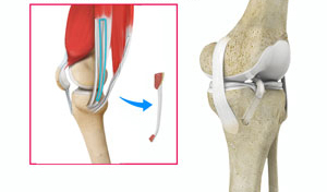 ACL Reconstruction Procedure of Hamstring Tendon