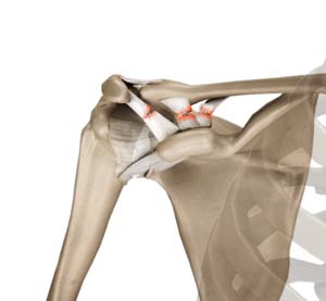 Acromioclavicular Joint (AC) Joint Reconstruction