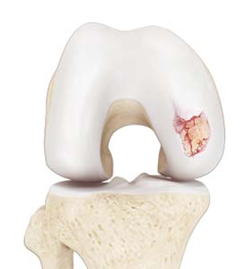 Chondral or Articular Cartilage Defects