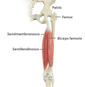 Proximal Hamstring Repair