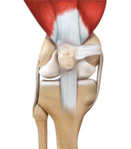 Medial Patellofemoral Ligament Reconstruction